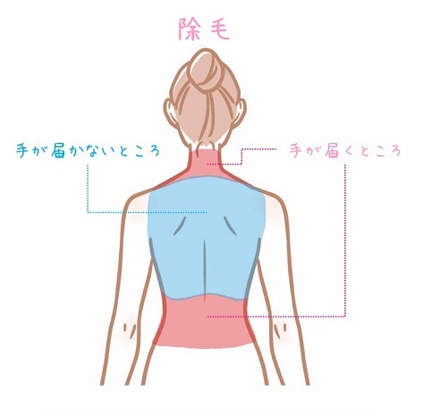 背中脱毛　一人で手が届く範囲と届かない範囲　除毛　図解